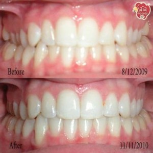 invisalign-13
