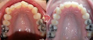 Invisalign